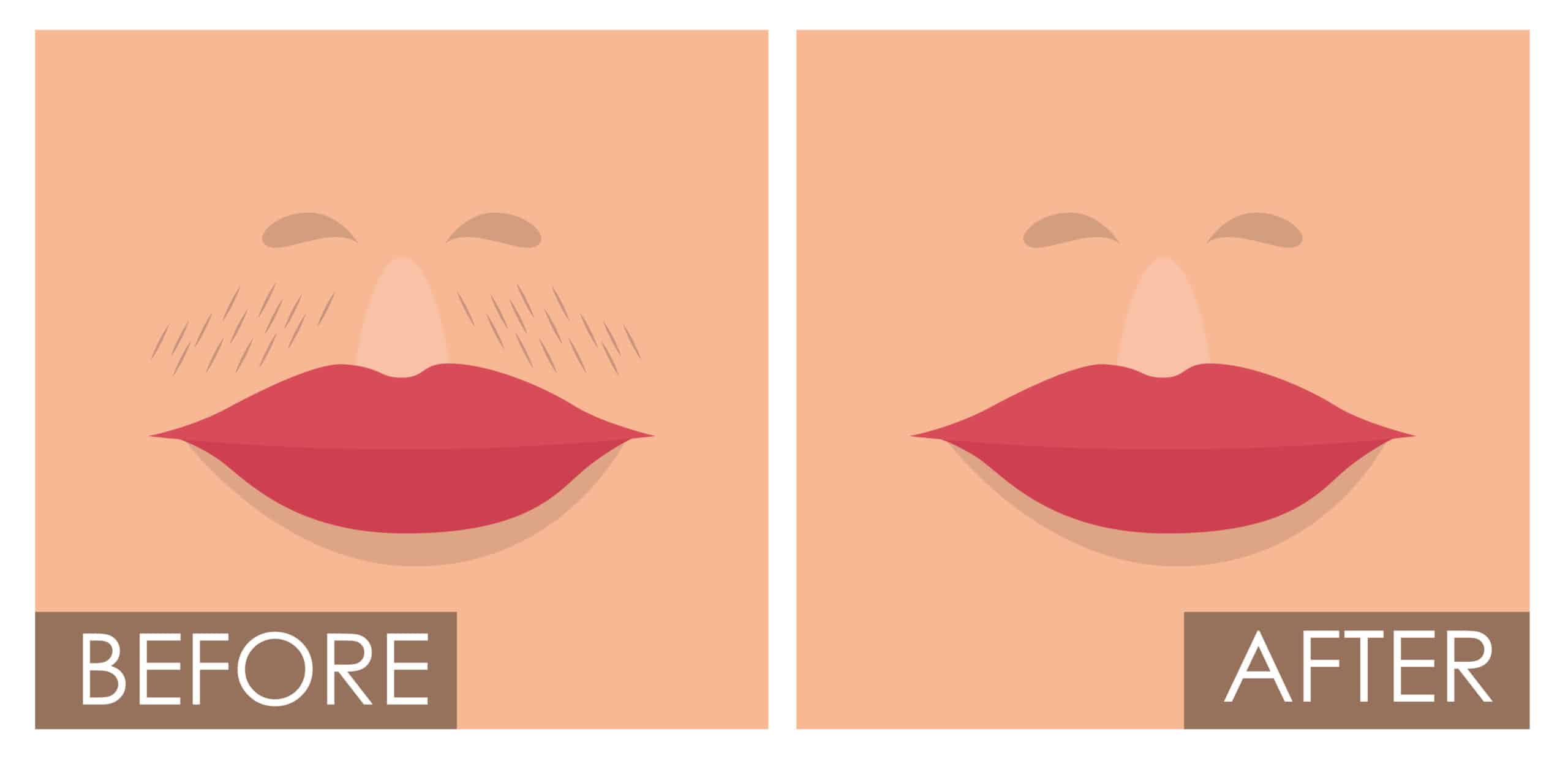 قبل و بعد ازالة الشعر بالليزر لمنطقة الشنب